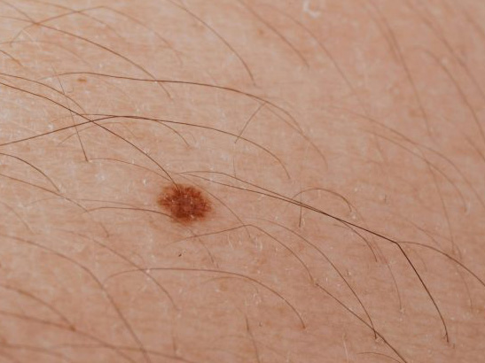 Understand the risks of Skin Cancer